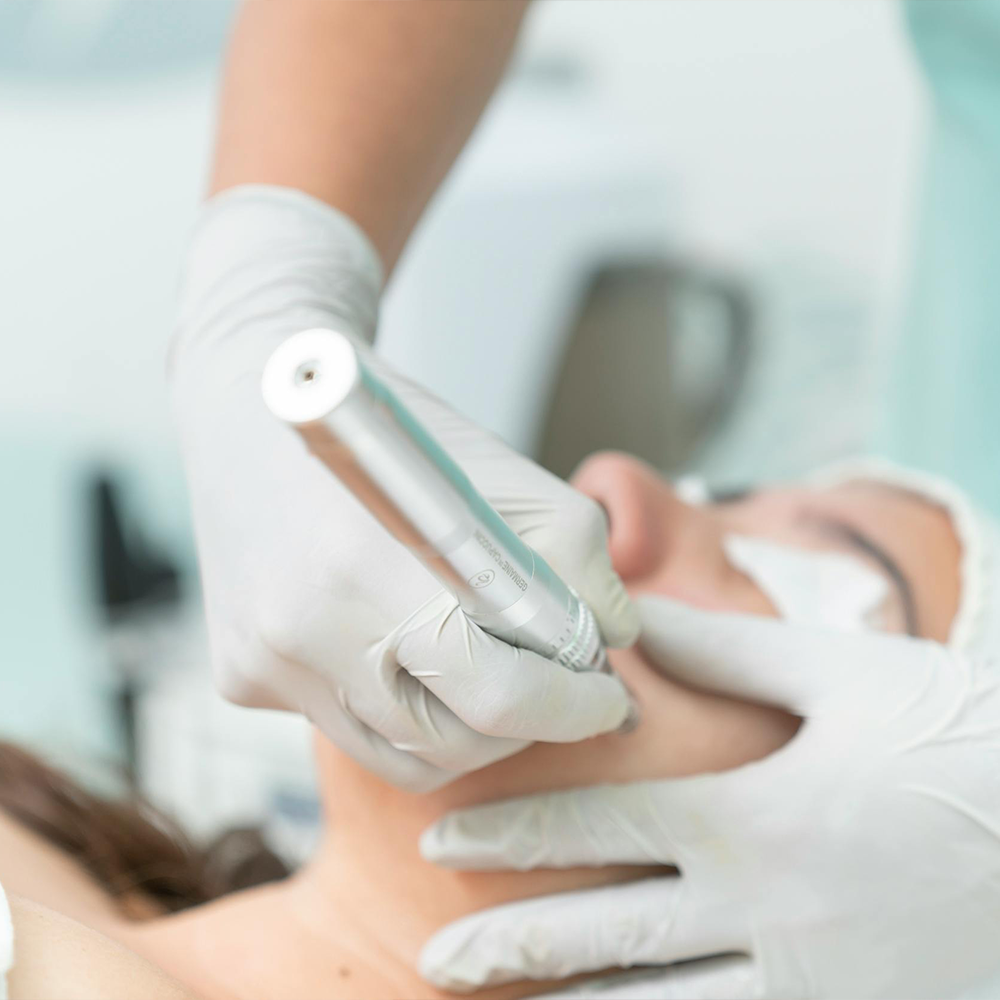 Microneedling Without PRP